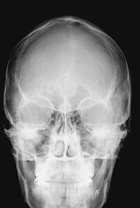 X-ray image of human skull