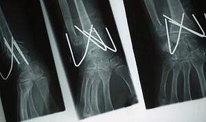 X-ray of pins in a wrist