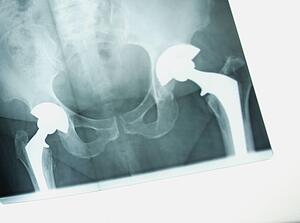 X-ray of a hip replacement