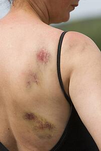 Bruising on woman's right shoulder and back