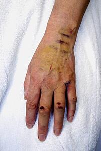 Cuts and bruises on a woman's hand 