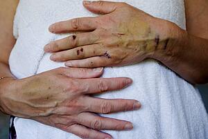 Injuries to a woman's hand and arm