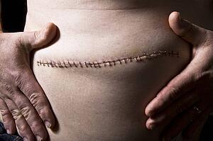 Stitches from surgery
