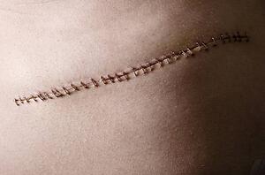 Stitches from surgery