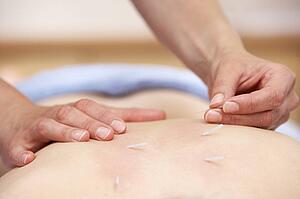 Acupuncturist treating female client