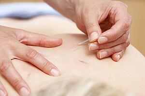 Acupuncturist treating female client