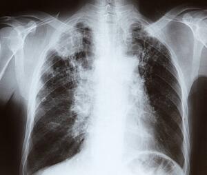Chest x-ray